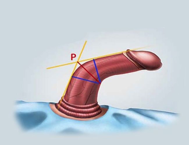 Peyronie là một trong những căn bệnh tàn phá đời sống tình dục của nam giới.