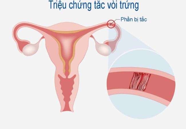 Giải đáp tắc vòi trứng có thụ tinh nhân tạo được không? 10 triệu chứng tắc vòi trứng
