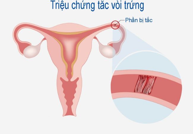 triệu chứng tắc vòi trứng