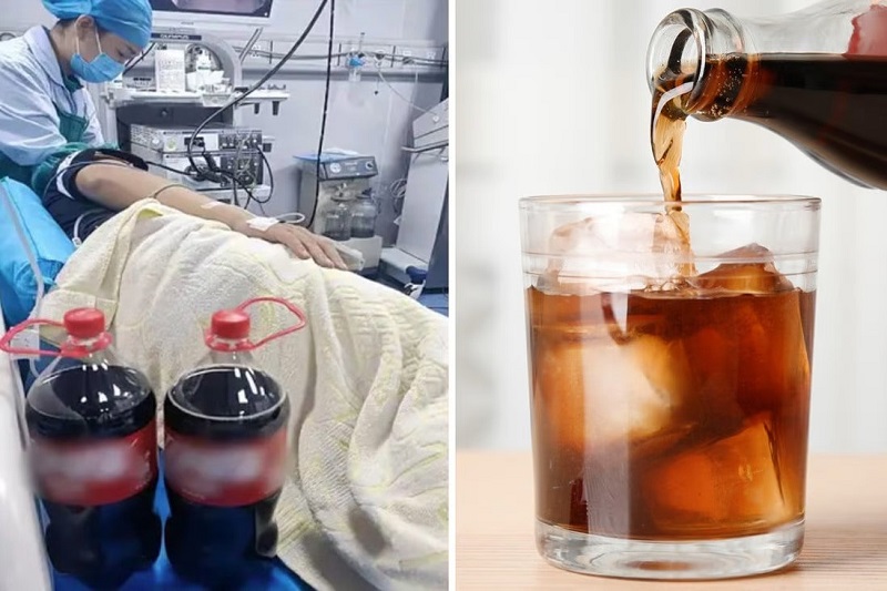 Nước ngọt điều trị sỏi dạ dày tốt cho sức khỏe 7 Nước ngọt trị sỏi dạ dày
